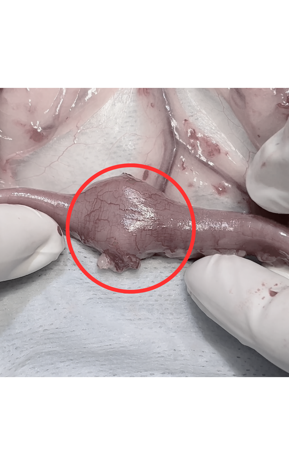 空腸のリンパ節腫大