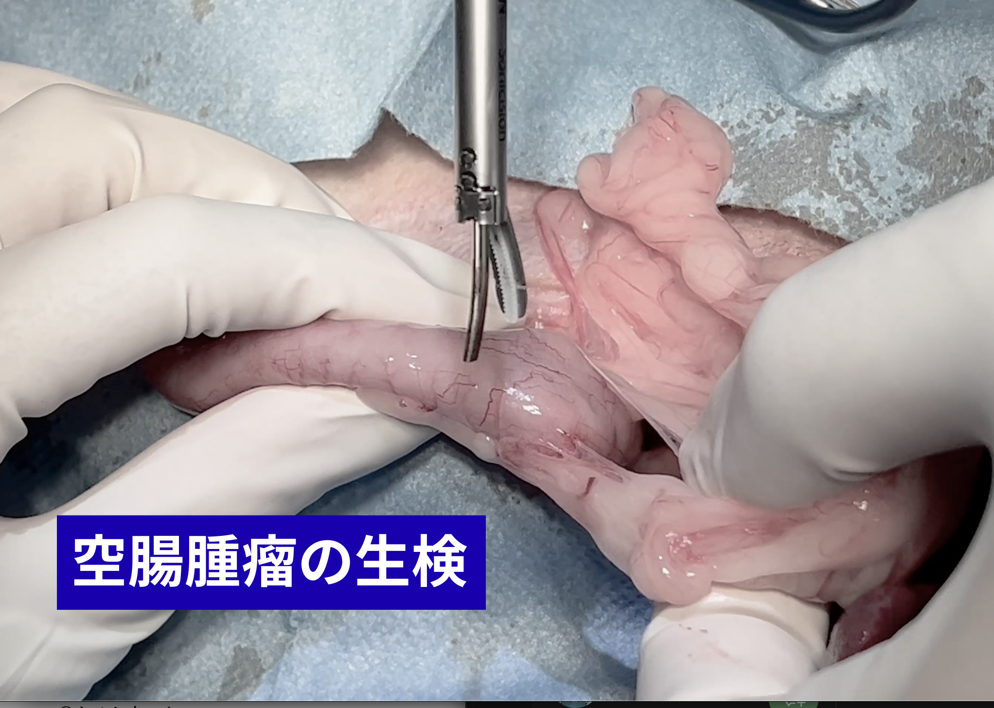 空腸腫瘤の生検