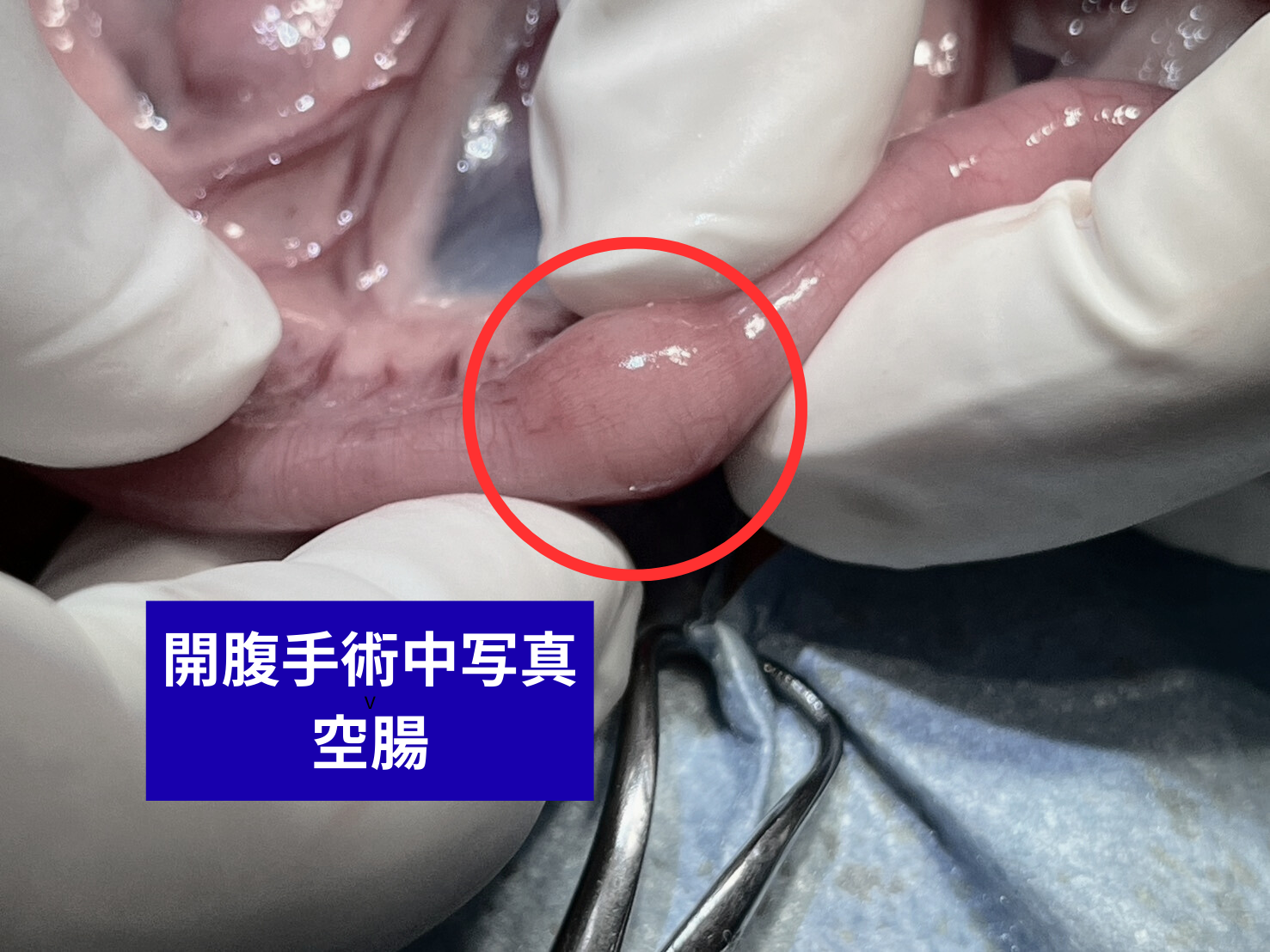 開腹手術中写真 空腸